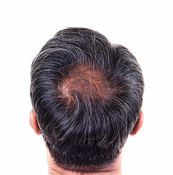 Haarausfall in Graz behandeln Behandeln Sie ihren Haarausfall